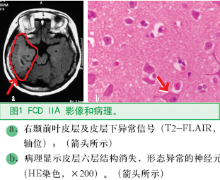 圖1 FCD IIA 影像和病理。