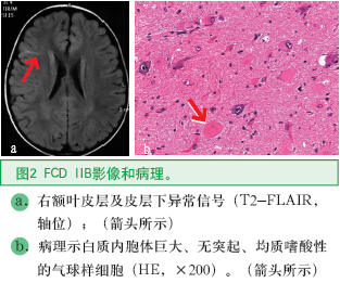 圖2 FCD IIB影像和病理。