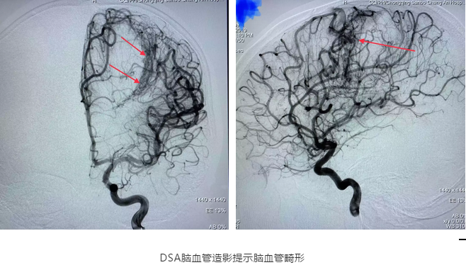 腦血管造影（DSA）證實(shí)為腦血管畸形