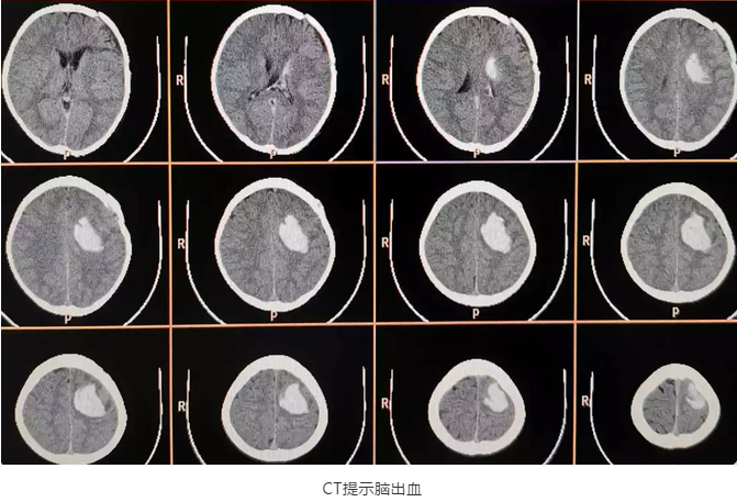 CT檢查確診為腦出血