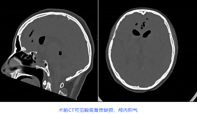 術前CT可見鞍底骨質缺損，顱內積氣