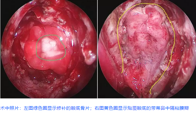 術中照片：左圖綠色圈顯示修補的鞍底骨片;右圖黃色圈顯示貼覆鞍底的帶蒂鼻中隔粘膜瓣