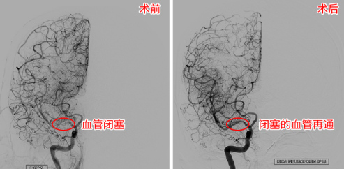 2個月內(nèi)腦梗2次 腦血管里“穿針引線”妙手“疏堵”