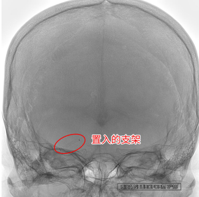 2個月內(nèi)腦梗2次 腦血管里“穿針引線”妙手“疏堵”