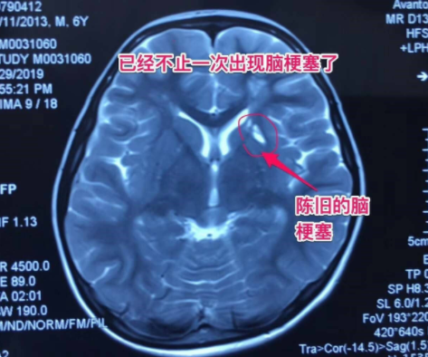 中老年多發(fā)腦梗，6歲兒童竟中招！說話不清、肢體無力、活動障礙、頭暈頭痛…要警惕！