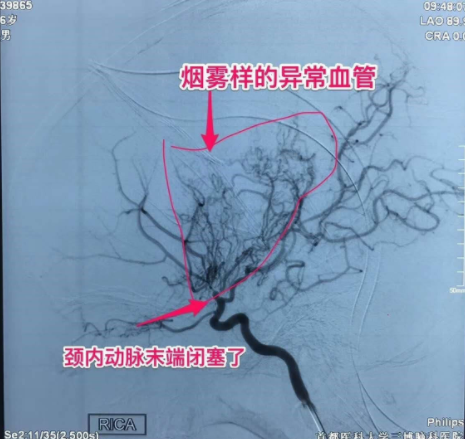 中老年多發(fā)腦梗，6歲兒童竟中招！說話不清、肢體無力、活動障礙、頭暈頭痛…要警惕！