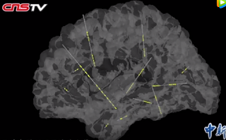 精準深入大腦深處 創(chuàng)傷小效率高，確定癲癇病灶