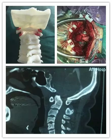 先天性顱頸畸形