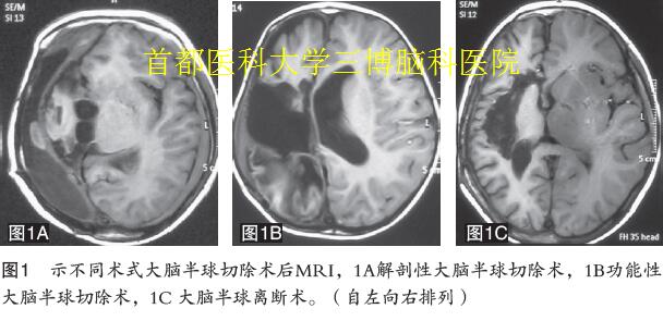 圖1 示不同術(shù)式大腦半球切除術(shù)后MRI，1A解剖性大腦半球切除術(shù)，1B功能性 大腦半球切除術(shù)，1C 大腦半球離斷術(shù)。（自左向右排列）