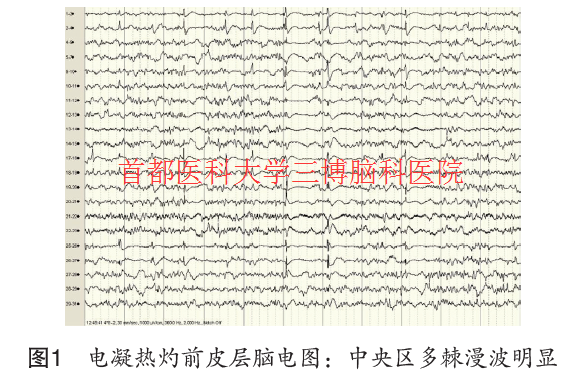 圖1 電凝熱灼前皮層腦電圖：中央區(qū)多棘漫波明顯