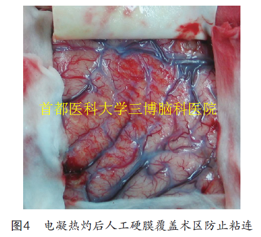 圖4 電凝熱灼后人工硬膜覆蓋術區(qū)防止粘連