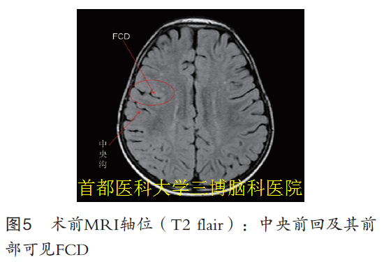 圖5 術前MRI軸位（T2 flair）：中央前回及其前 部可見FCD