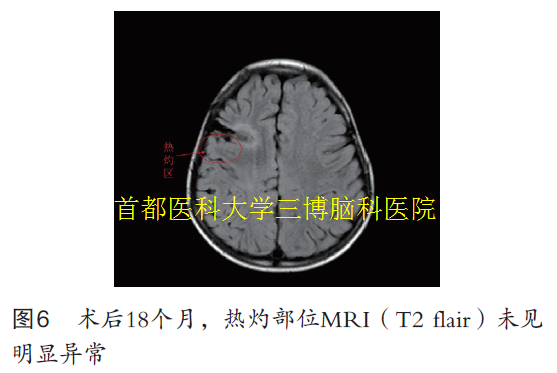 圖6 術后18個月，熱灼部位MRI（T2 flair）未見 明顯異常