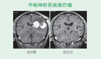 中樞神經(jīng)系統(tǒng)淋巴瘤