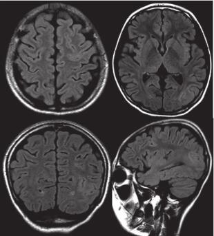 圖 2. 患者頭顱 MRI：左頂枕及左額葉皮層異常信號(hào)。