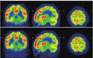 圖 3. 患者 PET：左側(cè)枕葉、顳、頂葉放射性攝取較對(duì) 側(cè)明顯減低。