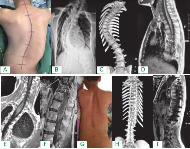 A: 術(shù)前大體像 B：術(shù)前立位平片 C：術(shù)前三 維 CT 重建 D：術(shù)前 MRI 矢狀位 E：術(shù)前 MRI 冠狀位 F：術(shù)前 MRI 胸段 G: 術(shù)后大體像 H： 術(shù)后三維 CT 重建 I：術(shù)后 MRI 矢狀位