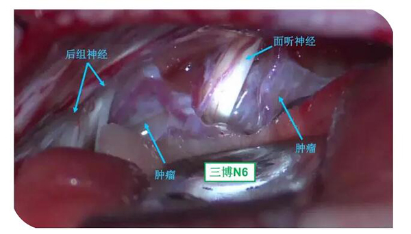 游離神經(jīng)，暴露腫瘤