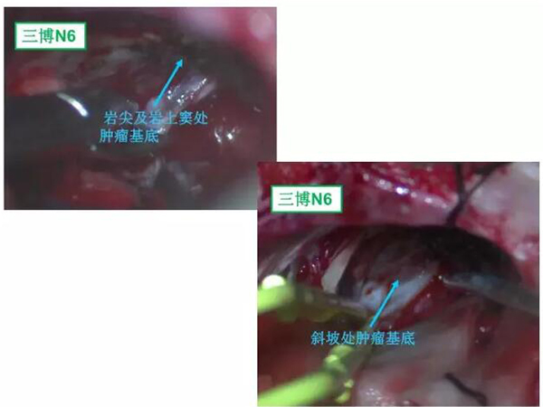 處理腫瘤基底