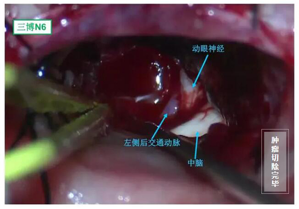 腫瘤切除完畢