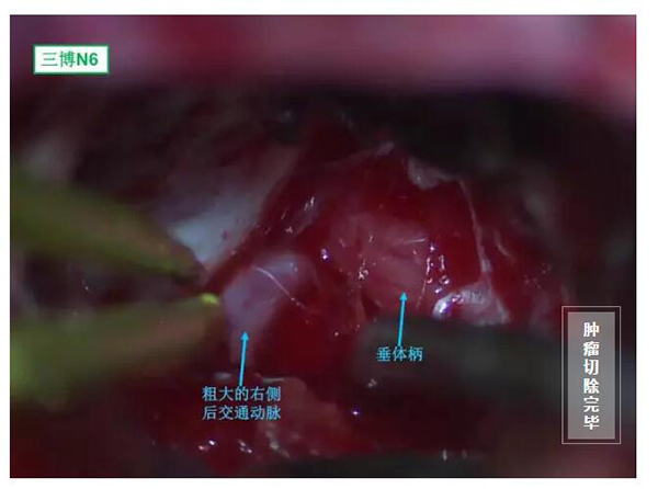 腫瘤切除完畢