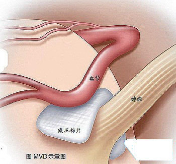 顯微血管減壓術(shù)治療面肌痙攣示意圖