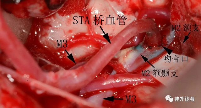 煙霧病術(shù)中照片，顯示相關(guān)結(jié)構(gòu)