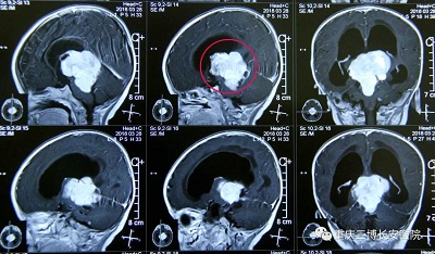 MRI：標注處為腫瘤