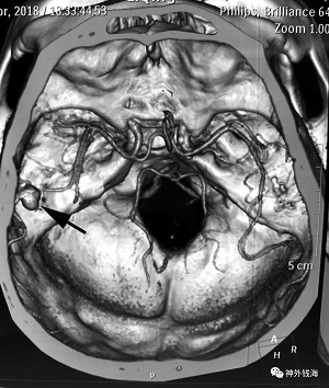 箭頭所示為動脈瘤