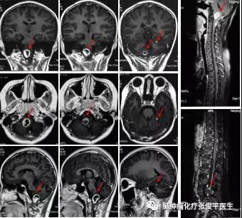 兒童延髓毛細(xì)胞型星形膠質(zhì)細(xì)胞瘤復(fù)發(fā)播散，該如何治療？