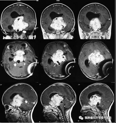 腫瘤由鞍區(qū)突入三腦室內(nèi)，并伴有后顱窩多處轉(zhuǎn)移