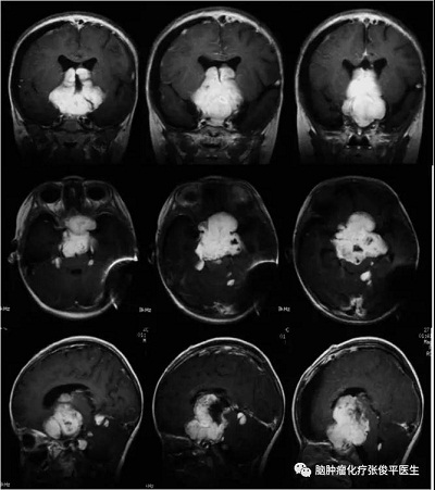 術(shù)后頭部MRI示：腫瘤部分切除