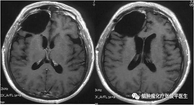 術(shù)后核磁，腫瘤全切