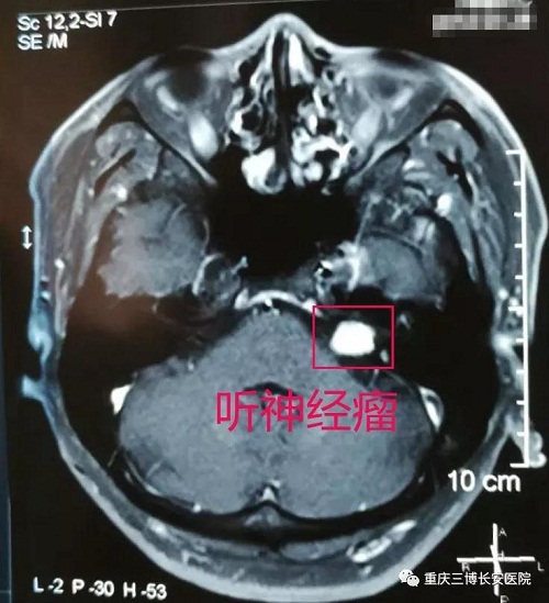 MRI：標注處為腫瘤