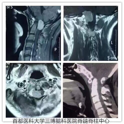 枕大孔區(qū)腦干延髓腹側(cè)腦膜瘤