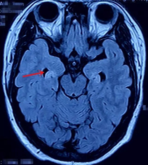 術(shù)前頭部MRI癲癇平掃