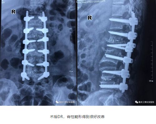 術后DR，脊柱畸形得到很好改善