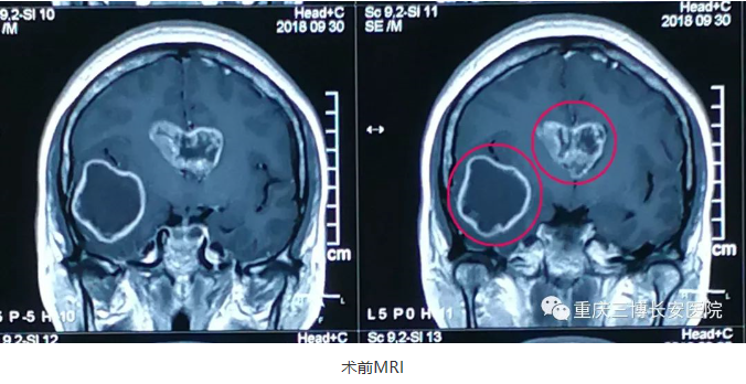 術(shù)前MRI