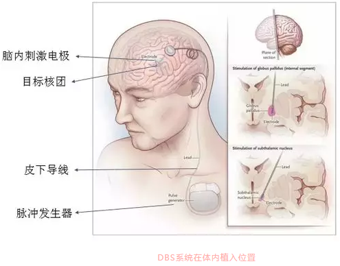 腦起搏器