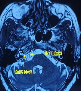 右眼跳”災(zāi)“？小心面肌痙攣！