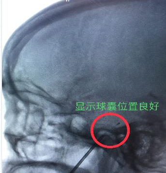 X光下可見黑色顯影導(dǎo)管位置良好