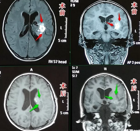 腦出血影像片