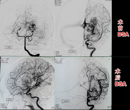 腦血管造影