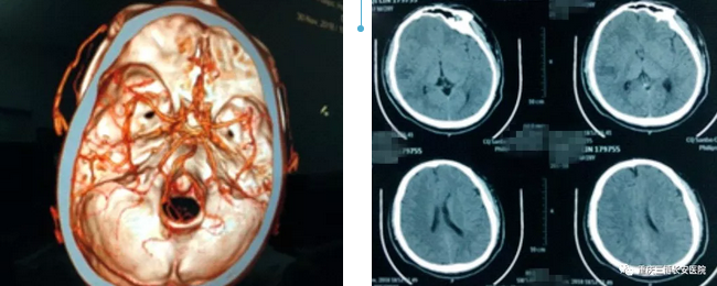 急診CT+CTA證實鄧先生發(fā)生急性腦梗死