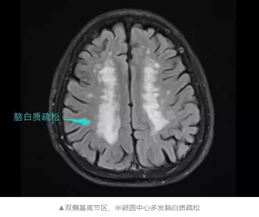 雙側(cè)基底節(jié)區(qū)、半卵圓中心多發(fā)腦白質(zhì)疏松