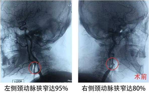 頸動脈被堵只剩“一線天” 外科微創(chuàng)疏通生命通道