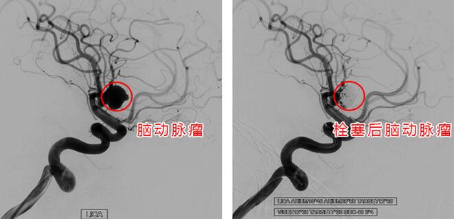 親人去世悲痛欲絕引發(fā)腦動(dòng)脈瘤破裂 醫(yī)生提醒：高危人群定期做腦部影像檢查