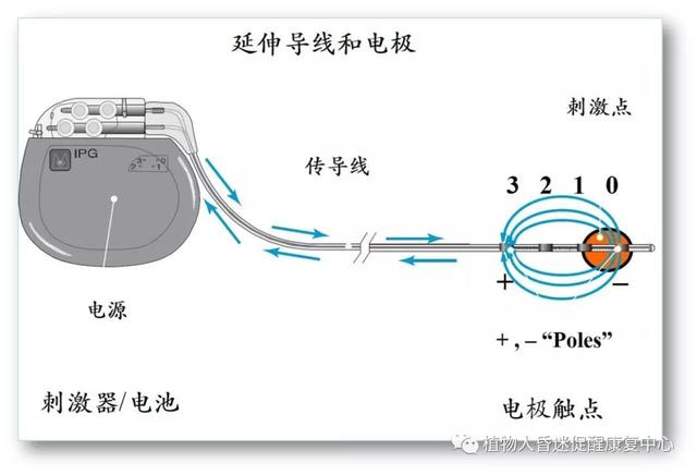 “植物人”真的無(wú)法醒過(guò)來(lái)嗎？這3種方法為昏迷促醒提供更多可能