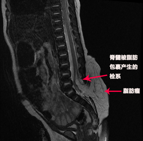 剛出生的寶寶屁股后有鵝蛋大的鼓包 醫(yī)生妙手修補脊柱裂