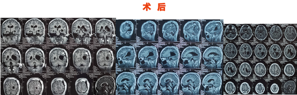 3歲有斗雞眼，父母忽視，13歲發(fā)現(xiàn)巨大腦腫瘤，這些癥狀需警惕!